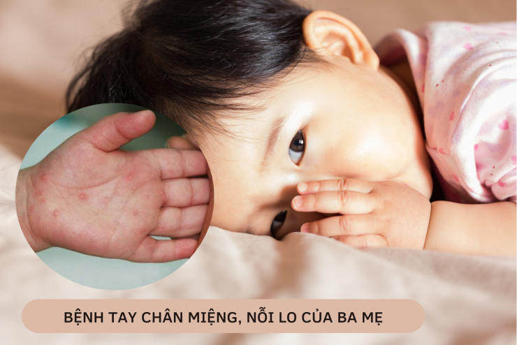 Bệnh tay chân miệng, nỗi lo của ba mẹ